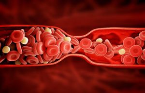 Testosterone Replacement Therapy: A Potential Cause of Blood Clots  1