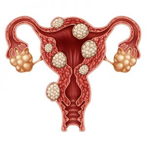 The 411 About Fibroids After Menopause  1