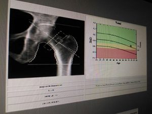 Melatonin to Improve Bone Density  1