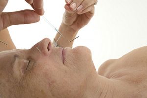 Acupuncture for Hot Flashes  1