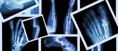 a look at osteoporotic fractures in men 2