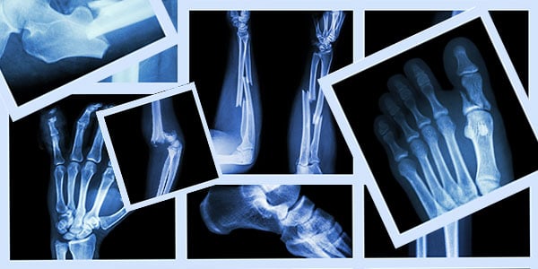 a look at osteoporotic fractures in men 2