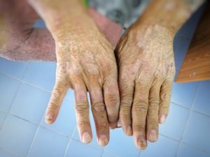 Managing Scleroderma and Aging