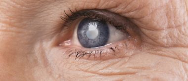 How Aging Hormones Influence Cataracts