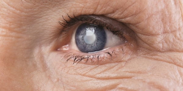 How Aging Hormones Influence Cataracts