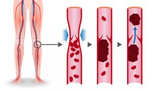 Inflammation, a Risk Factor for Stroke and Aging Health 1