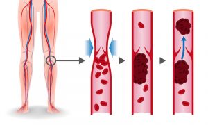 Inflammation, a Risk Factor for Stroke and Aging Health 1