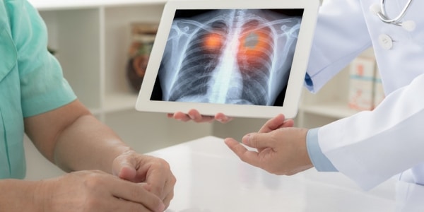 Increased Prevalence of Lung Cancer in Aging Men