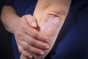 Managing Psoriasis as You Age 1