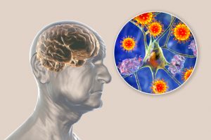 Research Finds COVID-19 May Increase Alzheimer’s-Like Symptoms and Risk of Disease 1