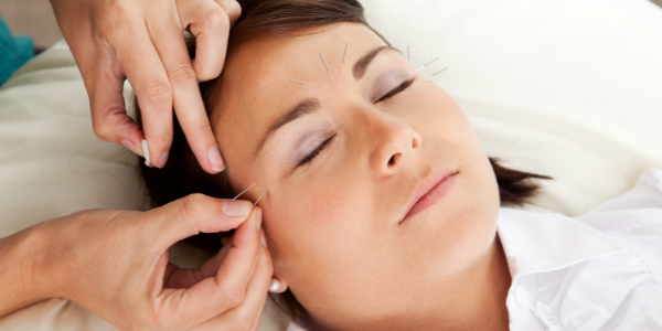 Relieving Menopausal Migraine With Acupuncture