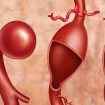 Arterial Stiffness in Old Age Increases the Risk of Heart Disease