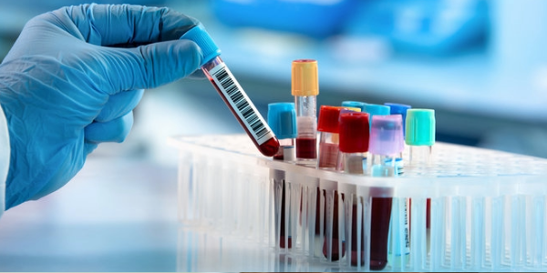 The Common Blood Test that Predicts How Quickly Alzheimer's Will Develop