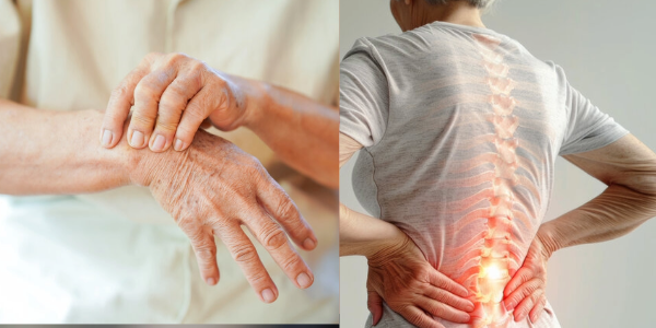 Two Key Genes Identified that Link Rheumatoid Arthritis and Osteoporosis 1