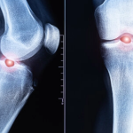 Scientists May Have Found a Way to Strengthen Bones for Life
