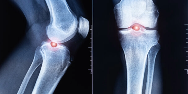 Scientists May Have Found a Way to Strengthen Bones for Life