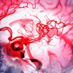 Scientists repair stroke damage with stem cells