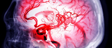 Scientists repair stroke damage with stem cells