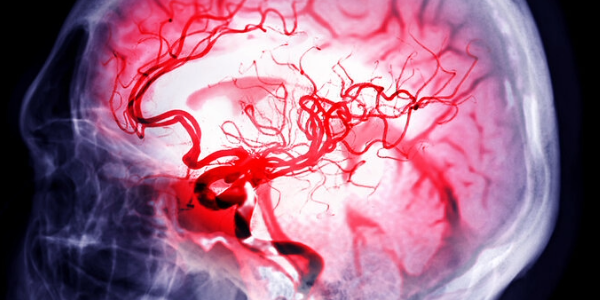 Scientists repair stroke damage with stem cells