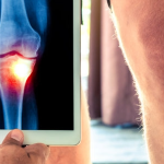 Simple Therapies are Often More Effective than Medication in Relieving Knee osteoarthritis.