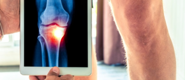 Simple Therapies are Often More Effective than Medication in Relieving Knee osteoarthritis.