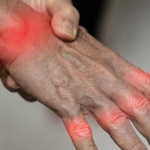 A Traditional Brazilian Plant Shows Unexpected Effectiveness Against Arthritis