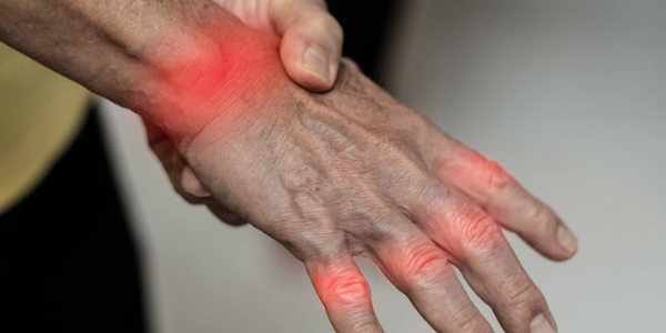 A Traditional Brazilian Plant Shows Unexpected Effectiveness Against Arthritis