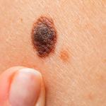 Malignant Melanoma: Low-Dose Treatment of Melanoma Delivers Significantly Better Results