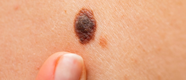 Malignant Melanoma: Low-Dose Treatment of Melanoma Delivers Significantly Better Results