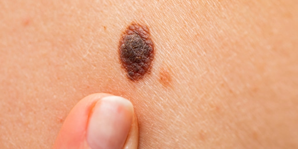 Malignant Melanoma: Low-Dose Treatment of Melanoma Delivers Significantly Better Results