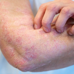 Scientists Uncover Why Psoriasis Can Lead to Joint Disease