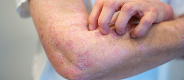 Scientists Uncover Why Psoriasis Can Lead to Joint Disease