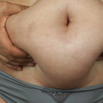 A New Way to Stop Dangerous Belly Fat as You Age 1