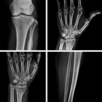 New Hope for Bones and Joints: Researchers Develop Regenerative Therapies