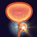 New Findings on Prostate Cancer: From Treatment Resistance to Diet