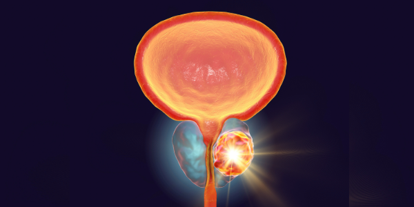 New Findings on Prostate Cancer: From Treatment Resistance to Diet